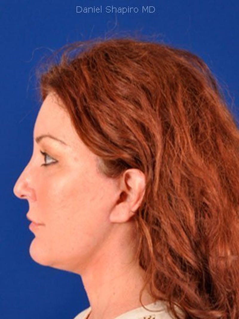 Facelift Before & After Gallery - Patient 10974324 - Image 6