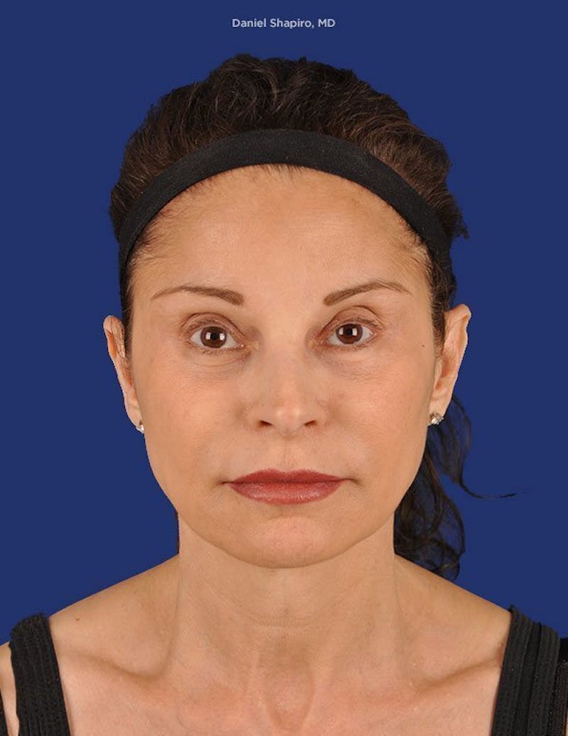 Facelift Before & After Gallery - Patient 10974326 - Image 1