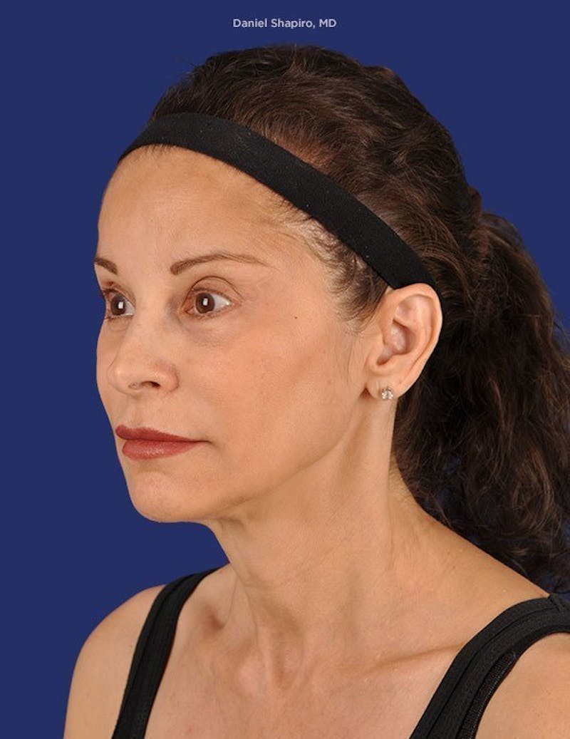 Facelift Before & After Gallery - Patient 10974326 - Image 3