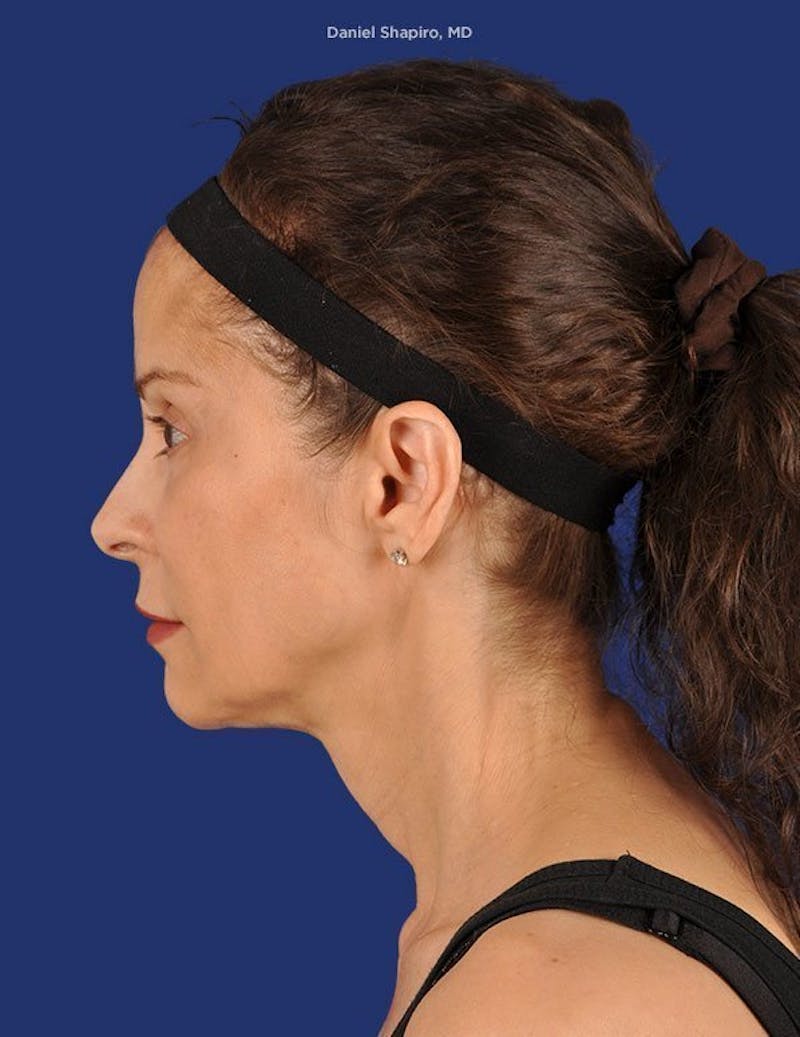 Facelift Before & After Gallery - Patient 10974326 - Image 5