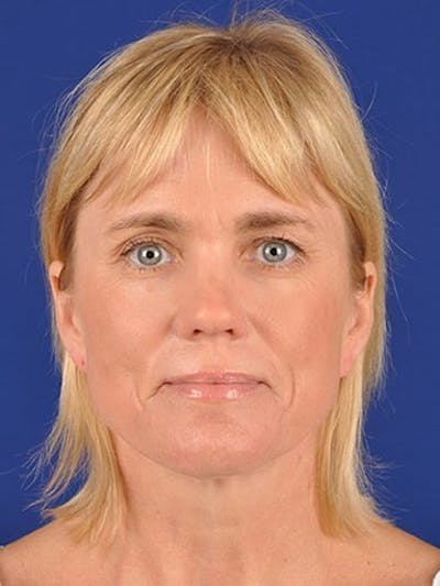 Facelift Before & After Gallery - Patient 10974328 - Image 1