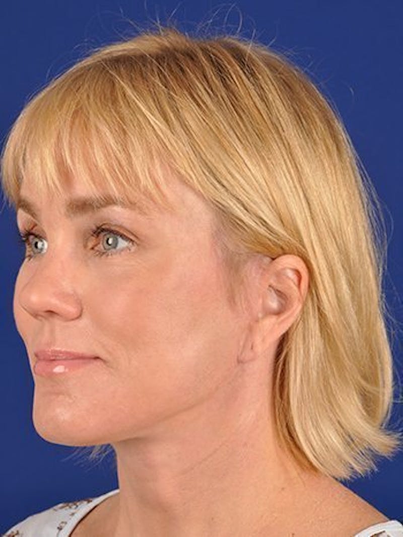 Facelift Before & After Gallery - Patient 10974328 - Image 4