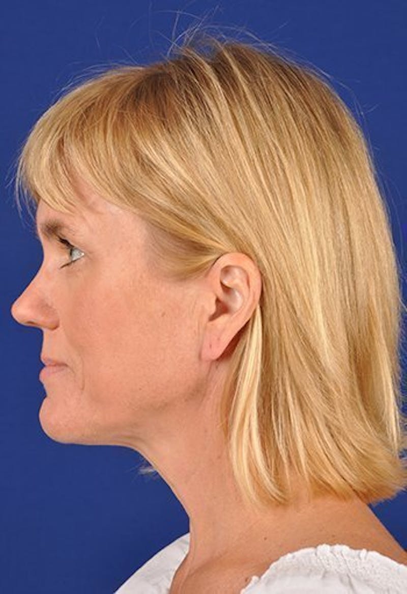 Facelift Before & After Gallery - Patient 10974328 - Image 5