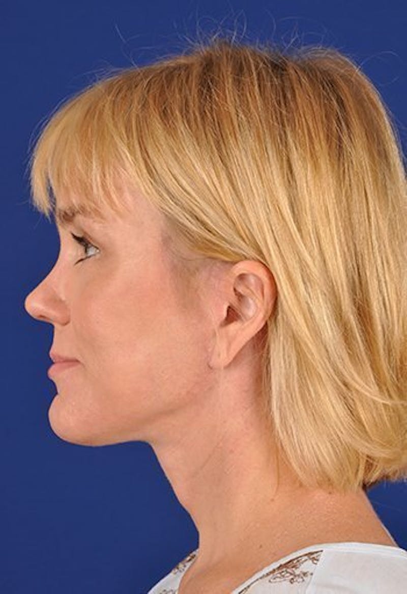 Facelift Before & After Gallery - Patient 10974328 - Image 6