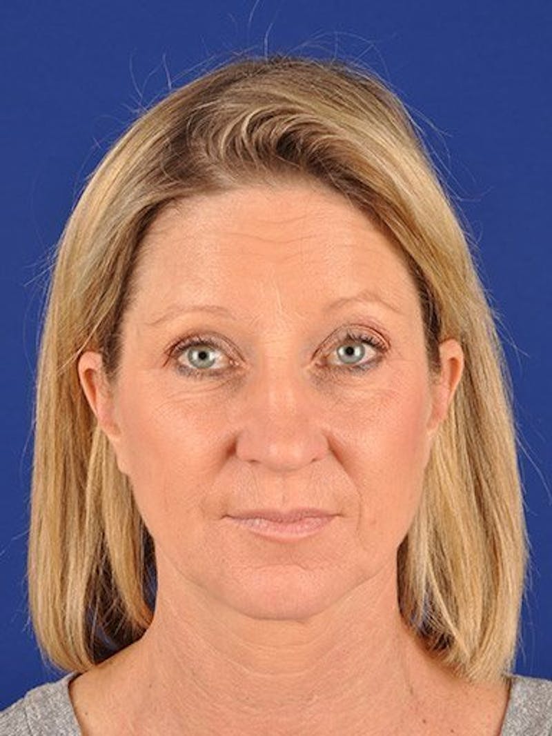 Facelift Before & After Gallery - Patient 10974329 - Image 1