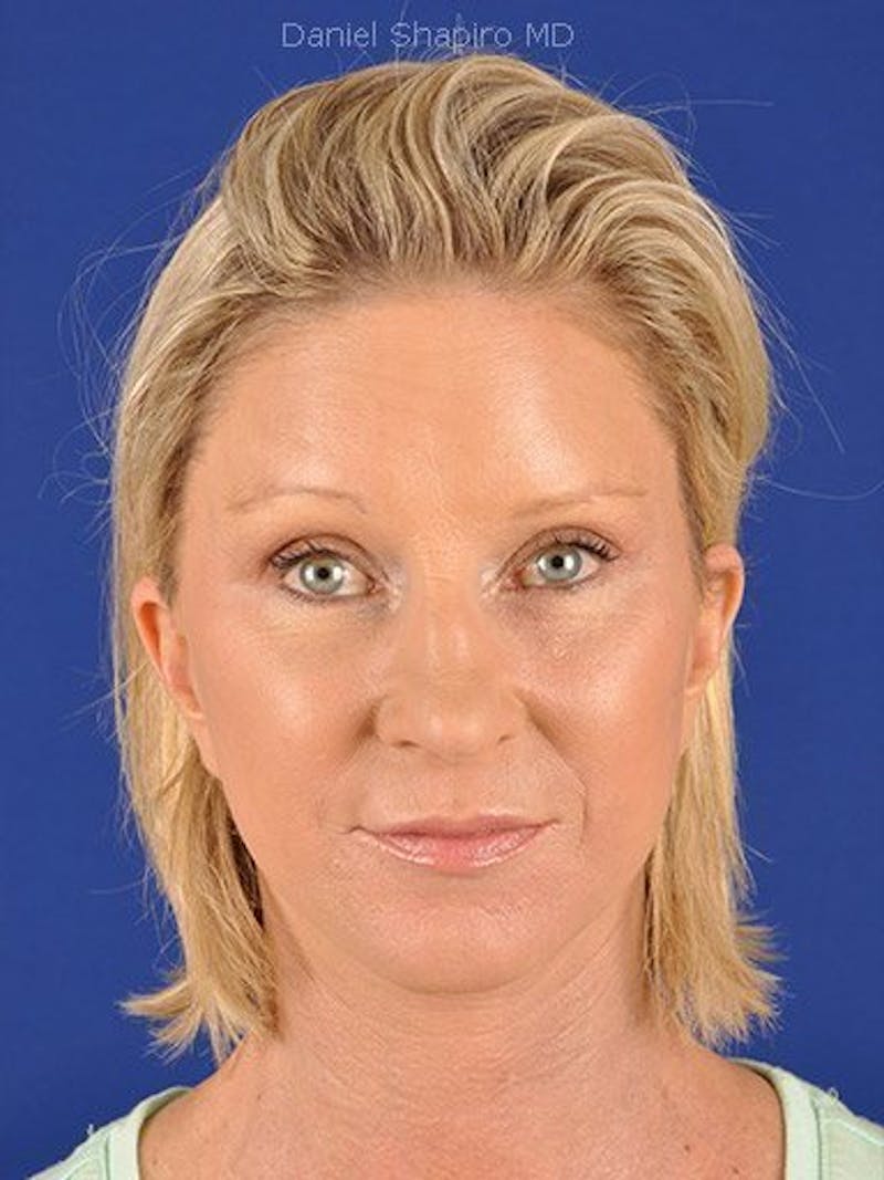 Facelift Before & After Gallery - Patient 10974329 - Image 2