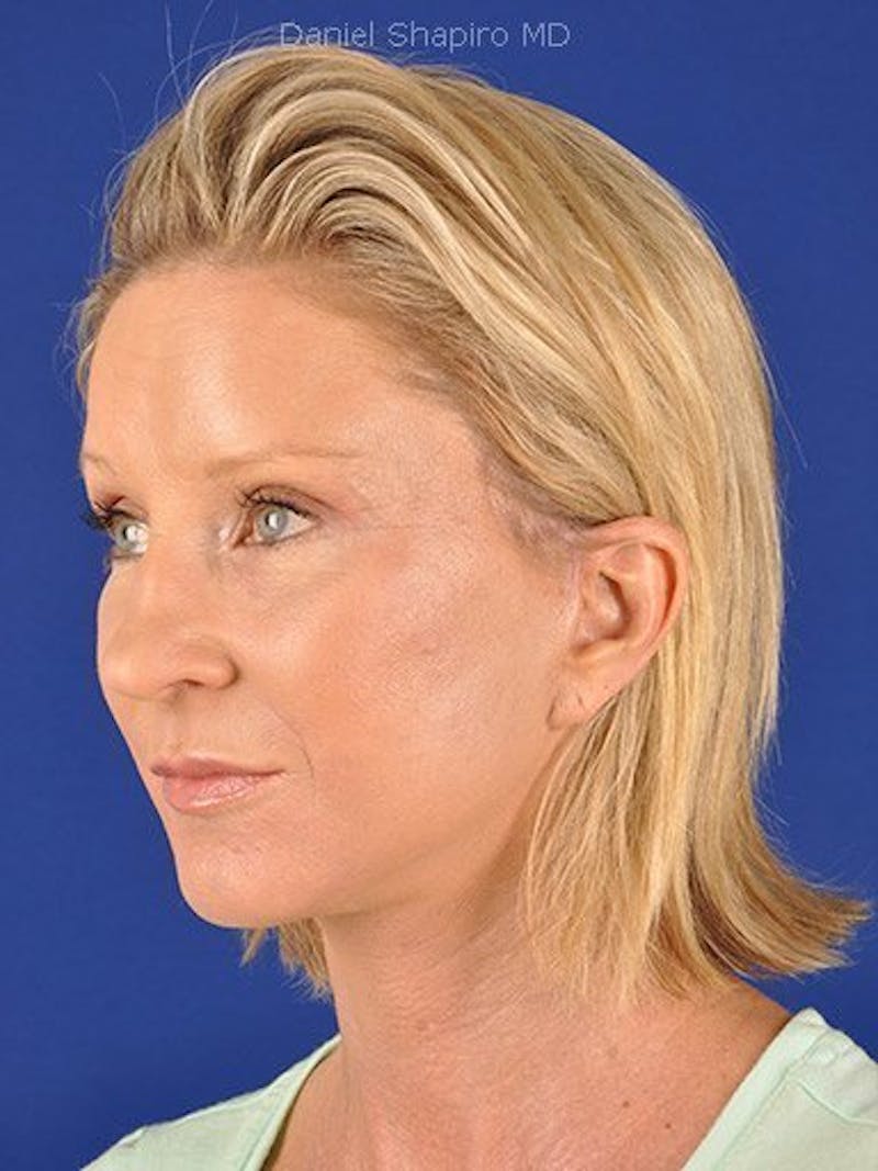 Facelift Before & After Gallery - Patient 10974329 - Image 4