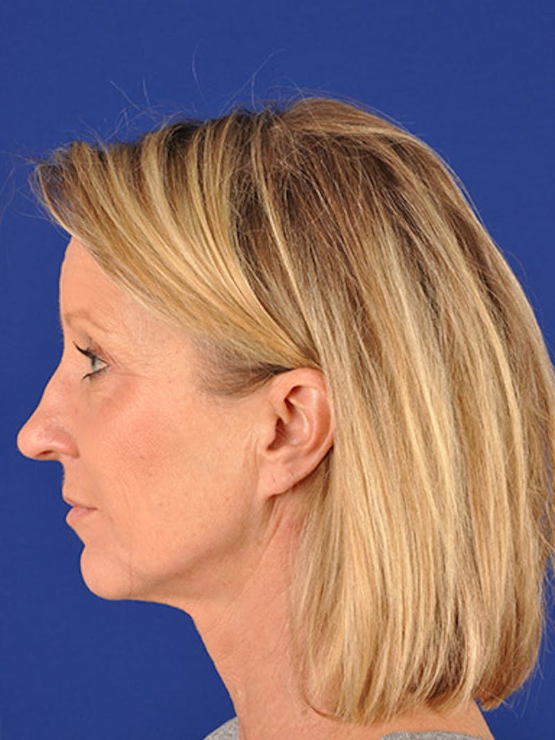Facelift Before & After Gallery - Patient 10974329 - Image 5