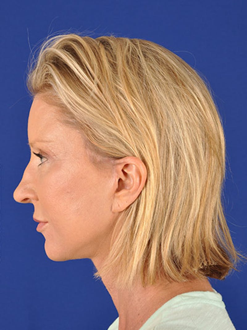 Facelift Before & After Gallery - Patient 10974329 - Image 6