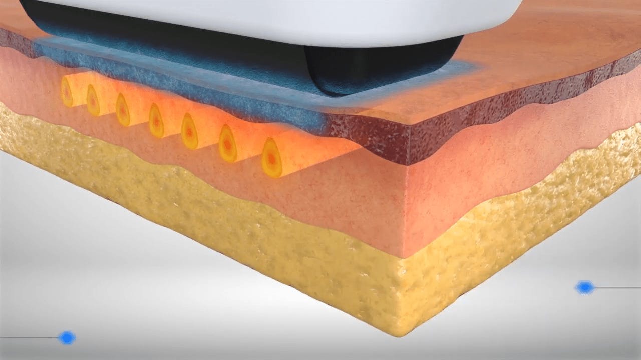 Softwave Intense Ultrasound