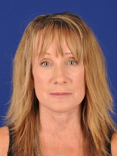 Facelift Before & After Gallery - Patient 17331336 - Image 2