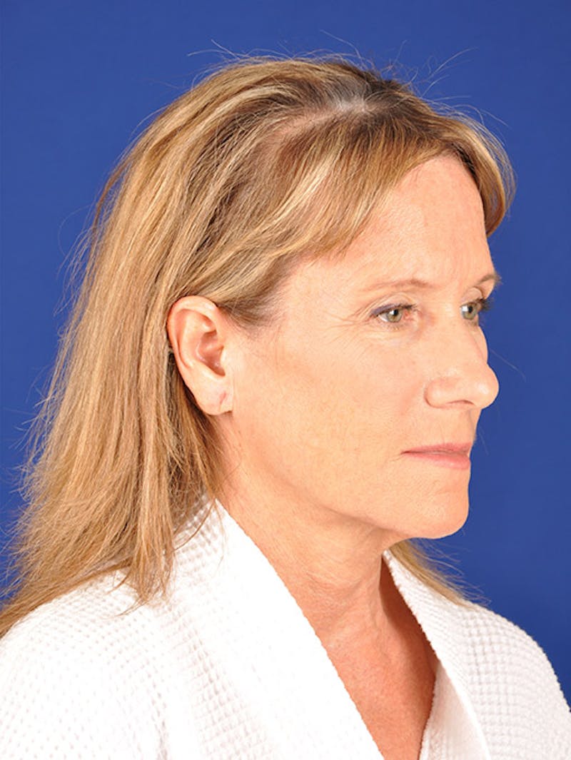 Facelift Before & After Gallery - Patient 17331336 - Image 3