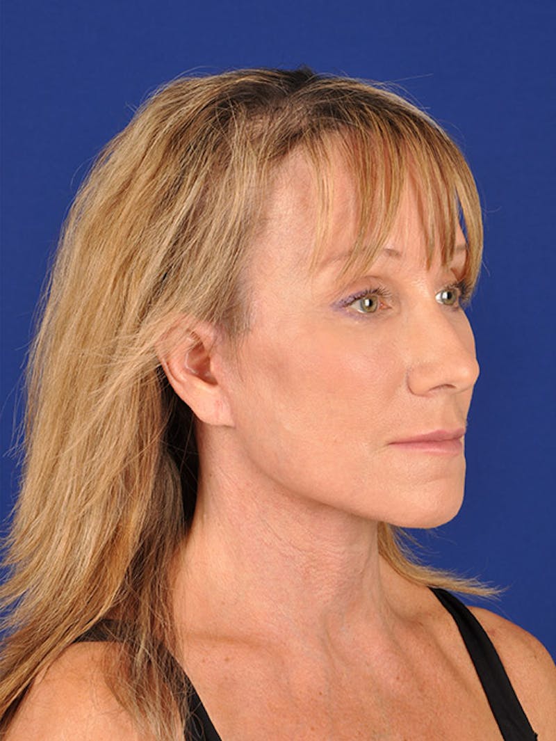 Facelift Before & After Gallery - Patient 17331336 - Image 4