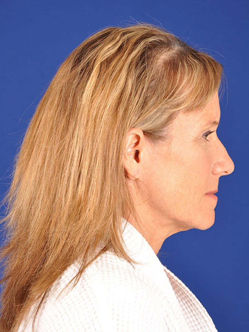 Facelift Before & After Gallery - Patient 17331336 - Image 5