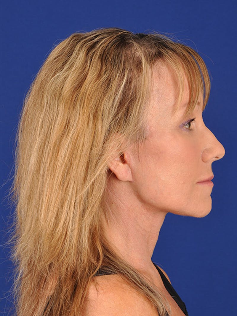Facelift Before & After Gallery - Patient 17331336 - Image 6