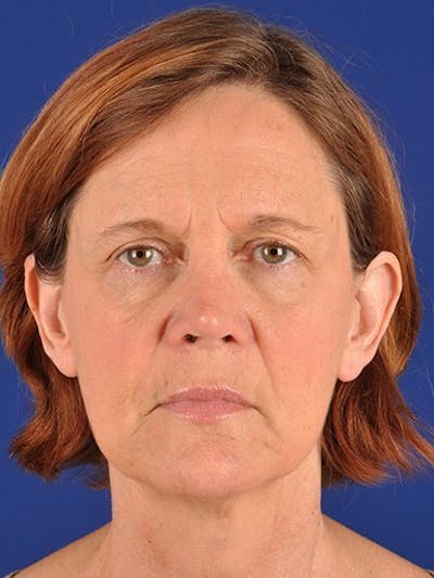 Facelift Before & After Gallery - Patient 17331338 - Image 1