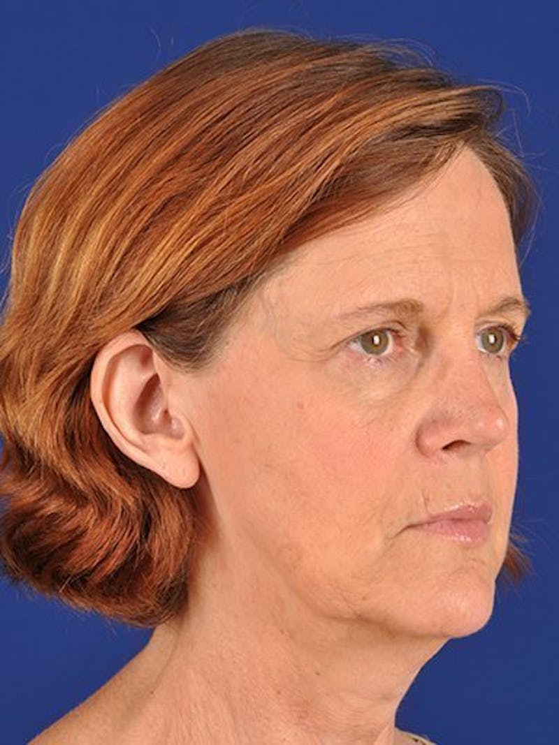 Facelift Before & After Gallery - Patient 17331338 - Image 3