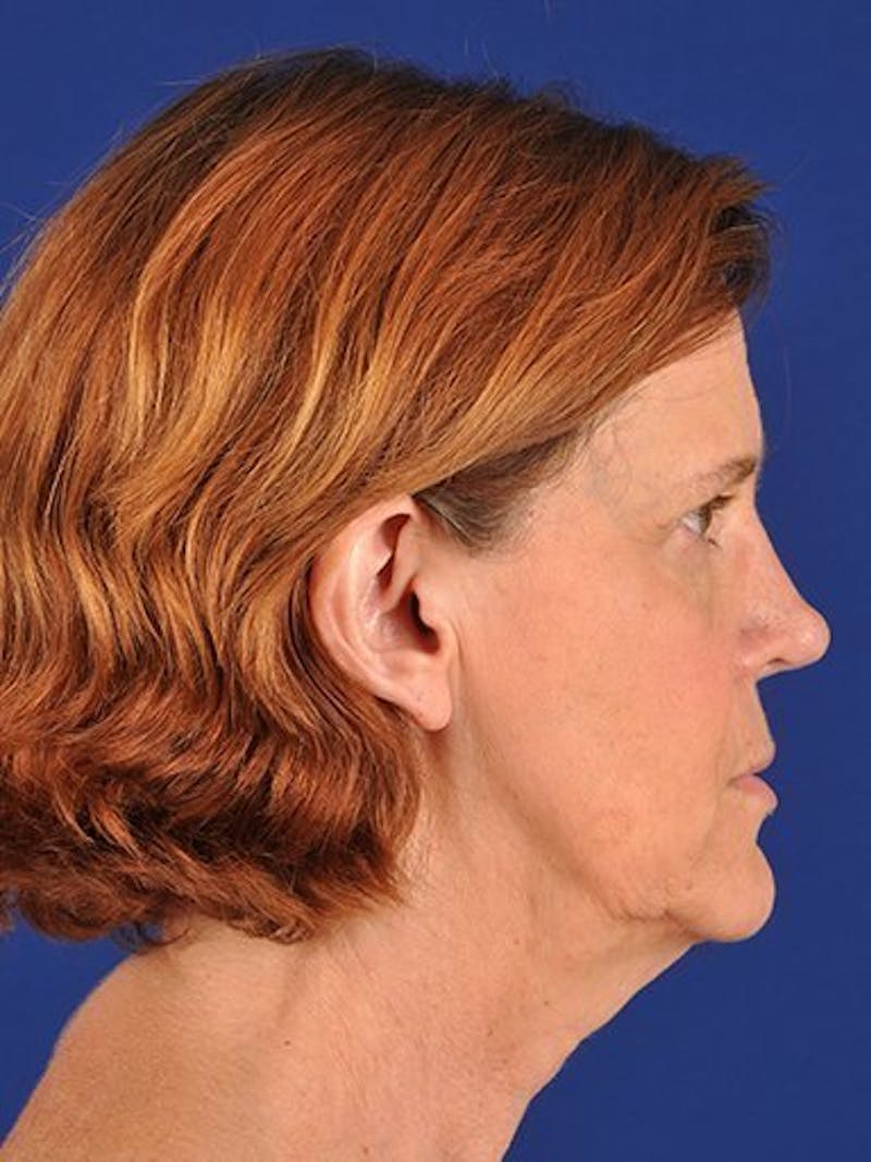 Facelift Before & After Gallery - Patient 17331338 - Image 5