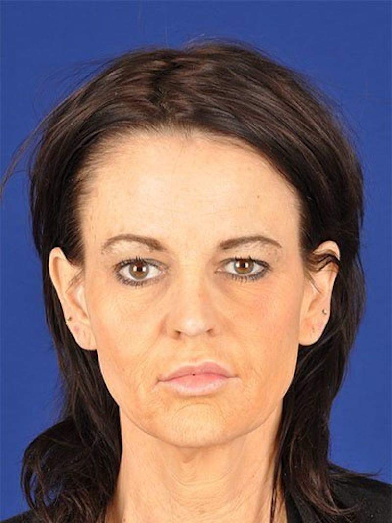 Facelift Before & After Gallery - Patient 17331340 - Image 1