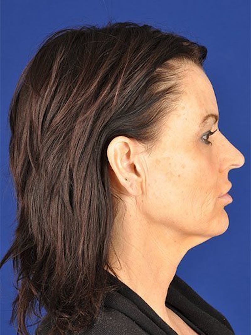 Facelift Before & After Gallery - Patient 17331340 - Image 3