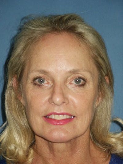 Facelift Before & After Gallery - Patient 17331346 - Image 1