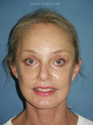 Facelift Before & After Gallery - Patient 17331346 - Image 2