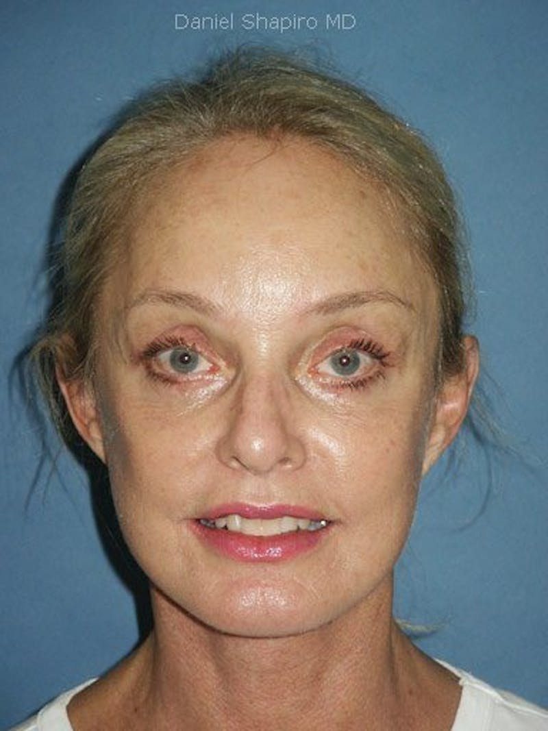 Facelift Before & After Gallery - Patient 17331346 - Image 2