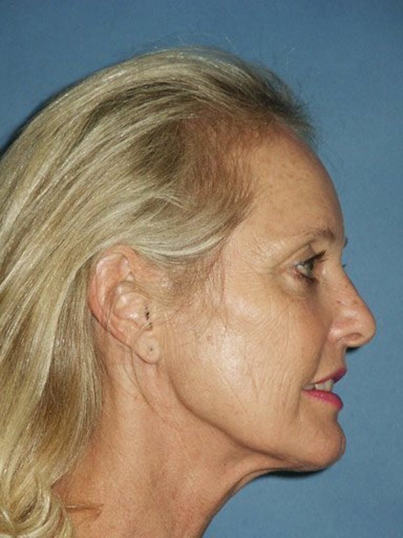 Facelift Before & After Gallery - Patient 17331346 - Image 3