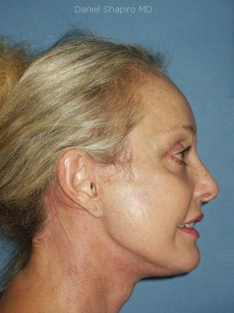 Facelift Before & After Gallery - Patient 17331346 - Image 4
