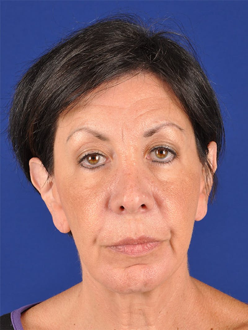 Facelift Before & After Gallery - Patient 17331350 - Image 1
