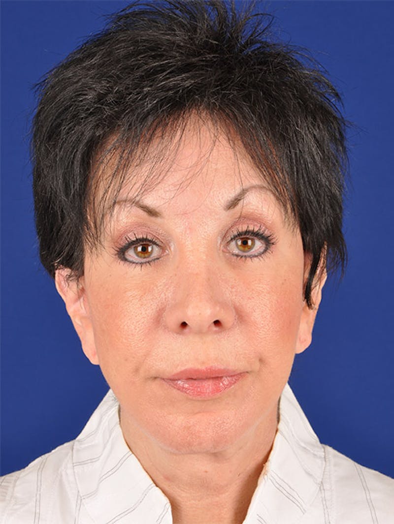 Facelift Before & After Gallery - Patient 17331350 - Image 2