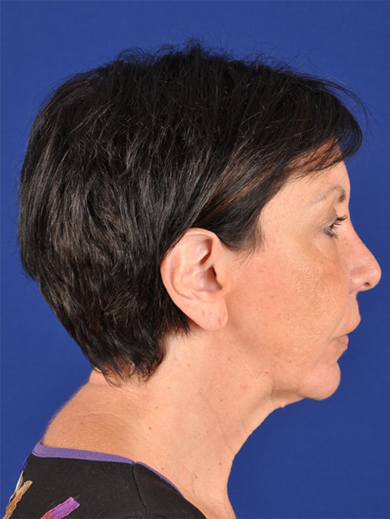 Facelift Before & After Gallery - Patient 17331350 - Image 5