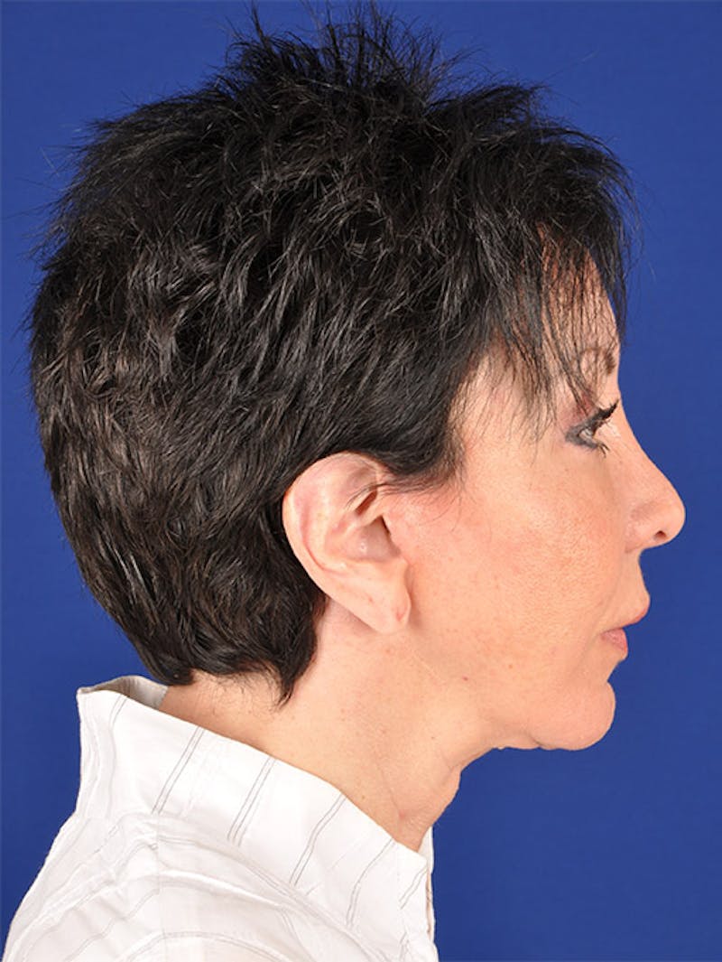 Facelift Before & After Gallery - Patient 17331350 - Image 6