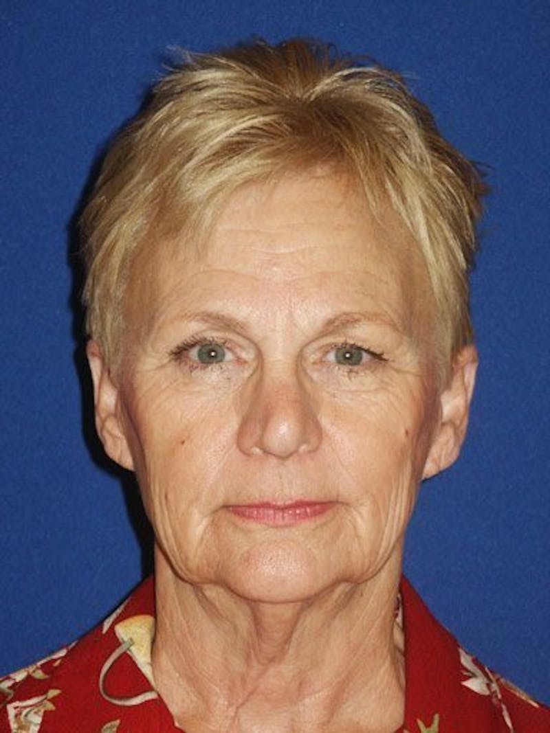 Facelift Before & After Gallery - Patient 17331352 - Image 1