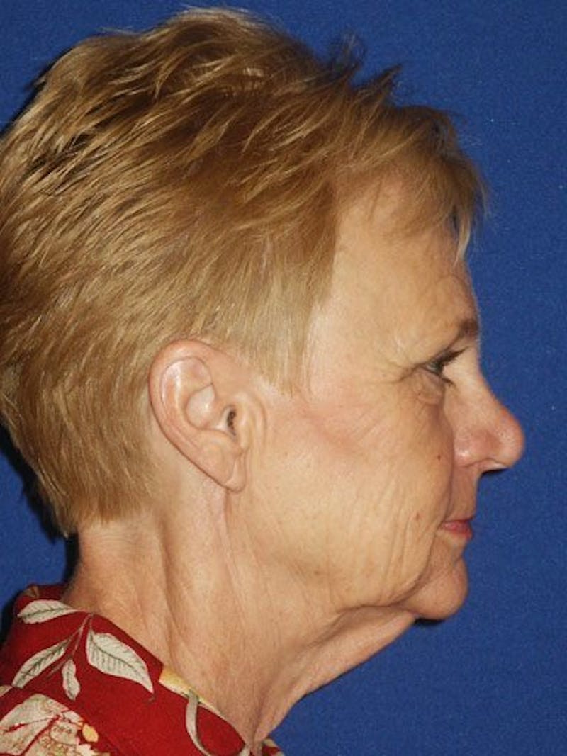Facelift Before & After Gallery - Patient 17331352 - Image 3