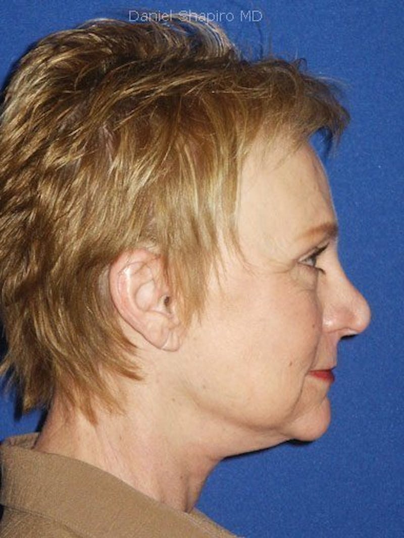 Facelift Before & After Gallery - Patient 17331352 - Image 4