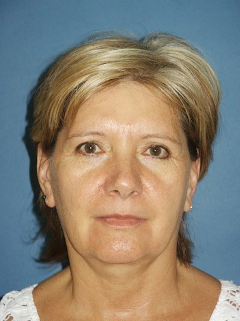 Facelift Before & After Gallery - Patient 17331354 - Image 1