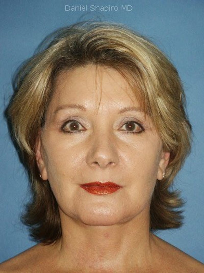 Facelift Before & After Gallery - Patient 17331354 - Image 2