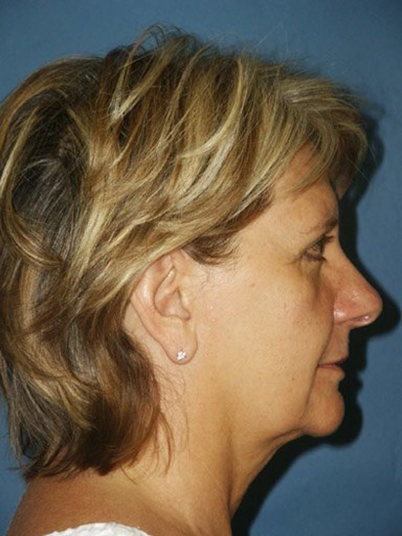 Facelift Before & After Gallery - Patient 17331354 - Image 3