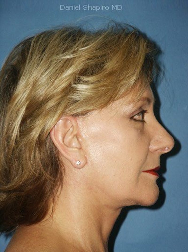 Facelift Before & After Gallery - Patient 17331354 - Image 4