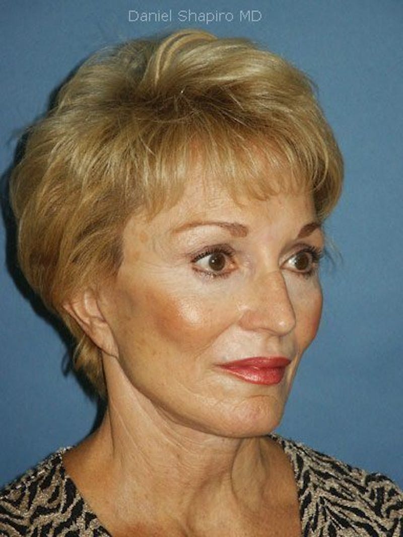 Facelift Before & After Gallery - Patient 17331355 - Image 4