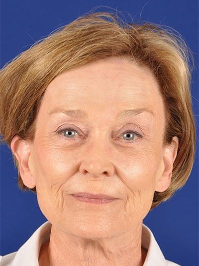 Facelift Before & After Gallery - Patient 17331356 - Image 1