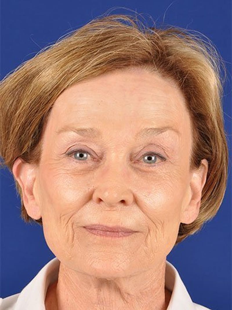Facelift Before & After Gallery - Patient 17331356 - Image 1