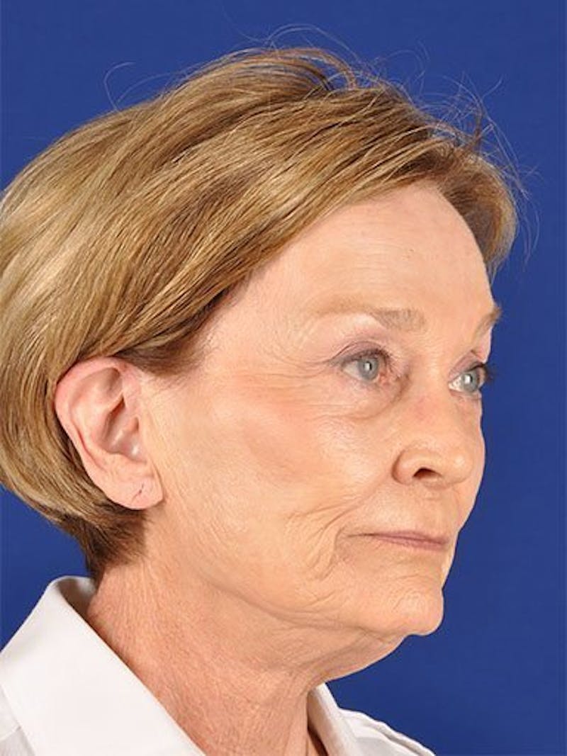 Facelift Before & After Gallery - Patient 17331356 - Image 3
