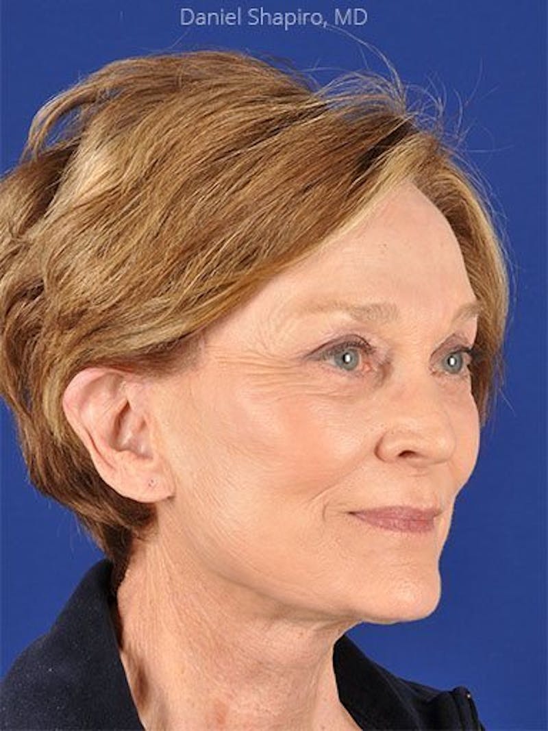 Facelift Before & After Gallery - Patient 17331356 - Image 4