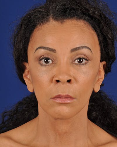 Facelift Before & After Gallery - Patient 17331359 - Image 2