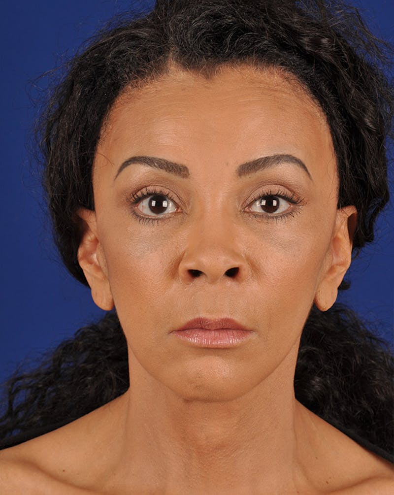 Facelift Before & After Gallery - Patient 17331359 - Image 2