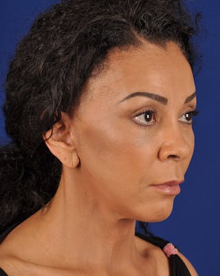 Facelift Before & After Gallery - Patient 17331359 - Image 4