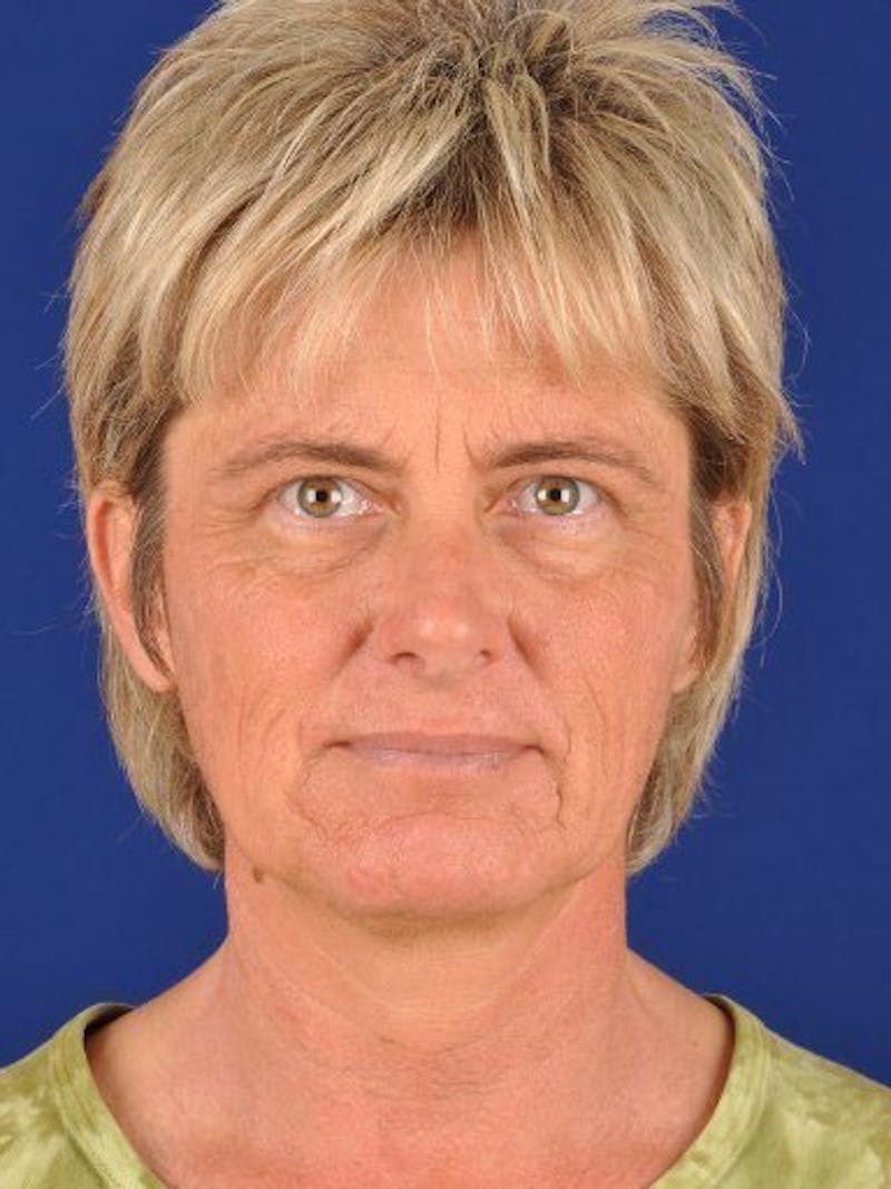Facelift Before & After Gallery - Patient 17331360 - Image 1