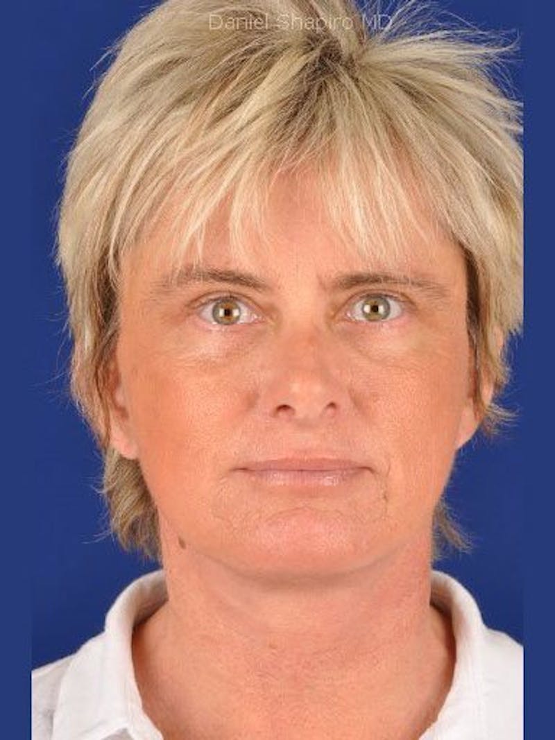 Facelift Before & After Gallery - Patient 17331360 - Image 2